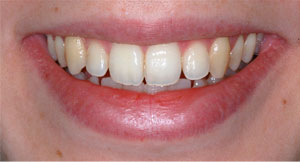 Sbiancamento dentale