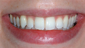 Sbiancamento dentale
